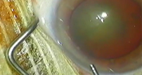 La chirurgie de la cataracte marseille