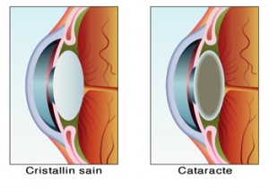 cataracte-pf